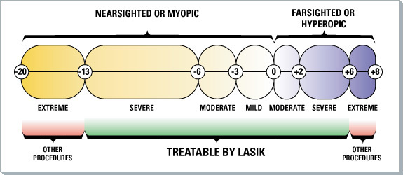 Nearsighted Prescription Chart